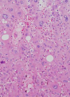 High risk factors Local invasion (recurrence) Metastasis Pathologic features Supportive evidence Yes Yes Yes/no Yes Focal atypical morphology Pseudoacinar Small cell