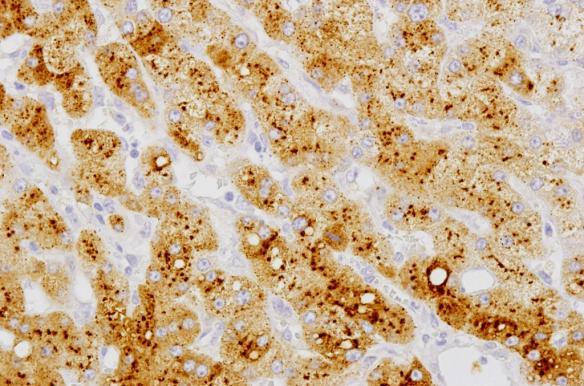 defining features HNF-1α inactivated HCA classification: immunohistochemistry L-FABP SAA CRP negative negative membranous perivascular