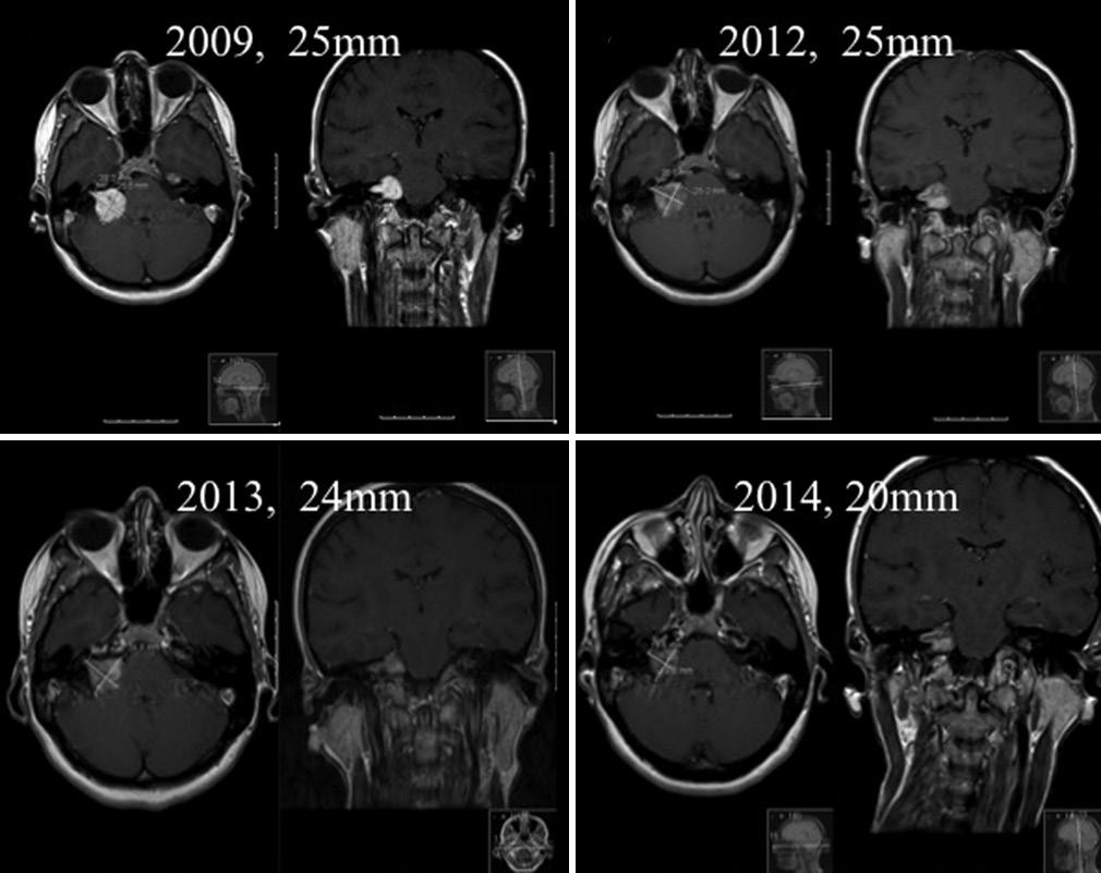 a c Figure 2: Right medium-sized (25 mm) vestibular schwannoma in 2009 (a) remaining stable in size in 2012 (b) and then showing a progressive reduction in size in 2013 (c) to a maximum intracranial