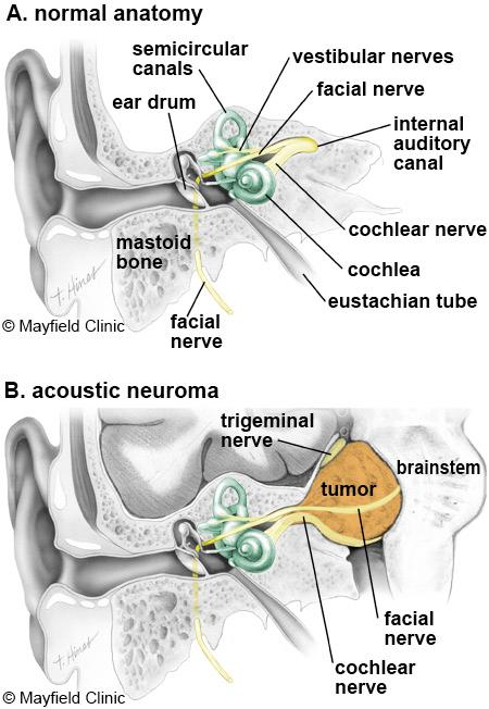 Acoustic Neuroma (vestibular schwannoma) basic level Overview An acoustic neuroma is a tumor that grows from the nerves responsible for balance and hearing.