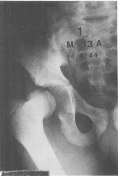 550 ANTONIO BARQUET Figure 1. An example of retroacetabular dislocation. Te femur as only suffered a rotatory movement, wit neiter lateral nor altitudinal displacement.