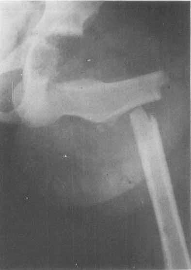 In bot cases, X-rays after manipulation sowed a greater gap between te femoral ead and te acetabulum tan on te contralateral side.