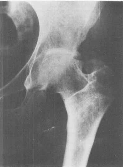 TRAUMATIC HIP DISLOCATION IN CHILDHOOD 55 1 Figure 4. Tirty-one years after dislocation. Tis was a case reduced by closed procedure 8 days after injury.