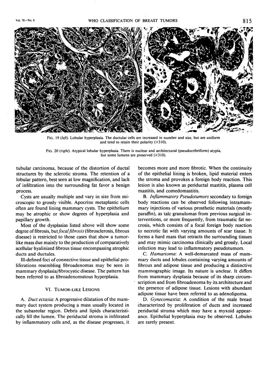 Vol. 78 No. 6 WHO CLASSIFICATION OF BREAST TUMORS 815 FIG. 19 (left). Lobular hyperplasia.