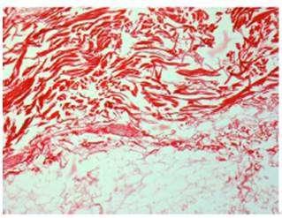 Figure 11: histological results of untreated skin and immediately after RFAL treatment The