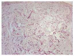 Figure 13: histological results of untreated skin and of RFAL-treated skin after 10 days in survival culture Even the study