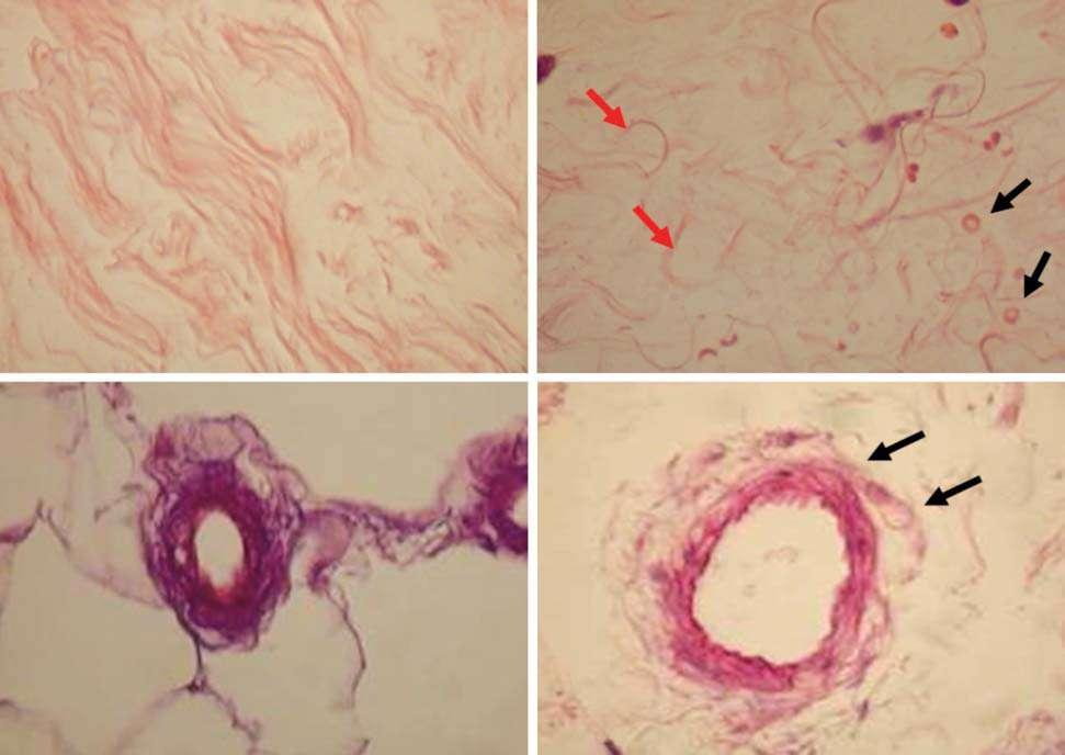 Figure 14: histological samples showing baseline collagen structure (left) and its changes with radiofrequency-assisted liposuction (right).
