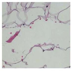 Figure 15: adipose tissue after RFAL treatment Figure 16: adipose tissue of a