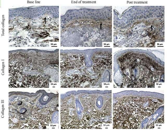 Figure 5: immunohistochemical staining for total collagen levels at baseline, end of treatment and 3 months post treatment Authors concluded that monopolar RF is an effective and valuable procedure