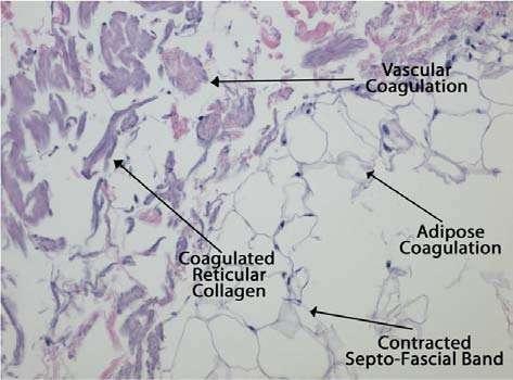reticular dermal collagen fibers,