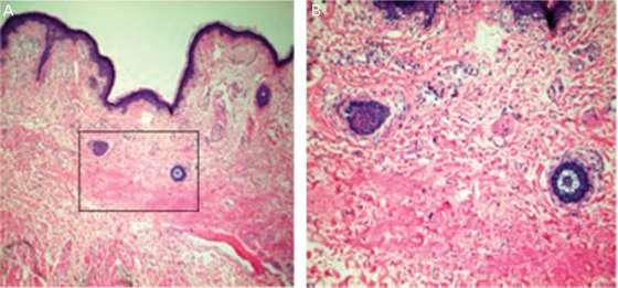 Figure 7: localized coagulative thermal necrosis of the hypodermal adipose tissue and deep reticular dermis. Biesman (3) evaluated the safety of a novel 0.