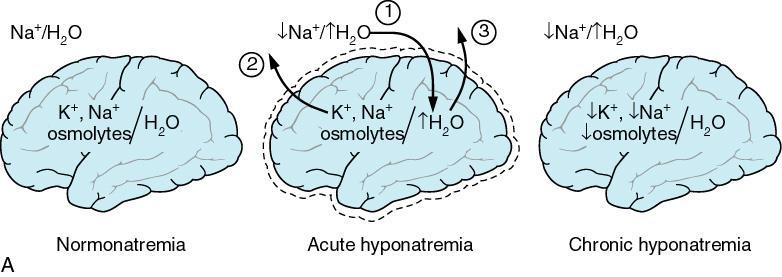 Classification of Symptoms of Hyponatremia All symptoms that can be signs of cerebral edema should be considered as severe or moderate symptoms that can be caused by hyponatremia Moderately Severe