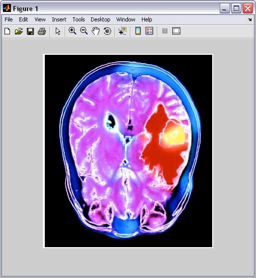 Figure 6- Uncorrupted image of brain tumor2 [5] As seen here in Figure 6 the image can easily be seen, and is colorful. The tumor portion is in the axial section of the human brain.