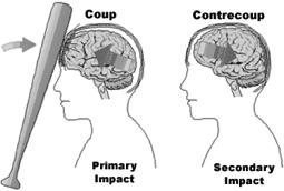gif Ø Bruising on the surface of the brain Ø Accelerationdeceleration injuries Ø S/S include: Ø N/V, LOC,