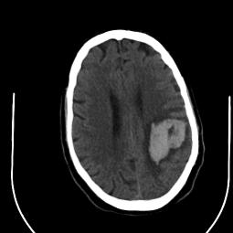 disipation of energy rupturing bridging veins S/S: LOC, hemiparresis, fixed, dilated pupils Surgical intervention w/i 4 hours SUBACUTE 48hrs-2 weeks post