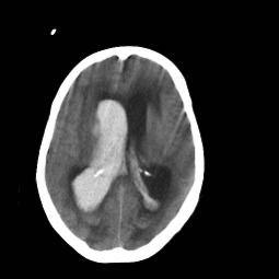 ascertain cause Tolerate initally by elderly d/t atrophy Surgical intervention Burr holes Subdural drains http://img.medscape.