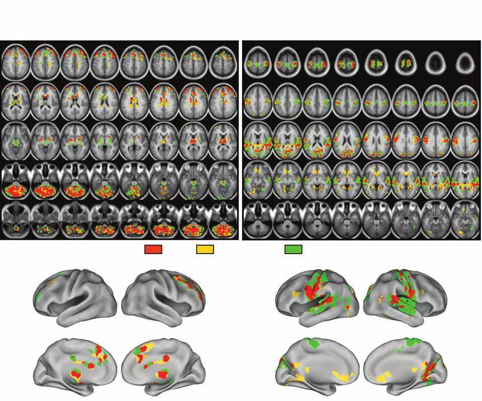 Mediodorsal Thalamic Connectivity in Schizophrenia a Overlap Between MD and LGN Seeds: HCS>SCZ c Overlap Between MD and LGN Seeds: SCZ>HCS Volume View Surface View b lateral - L medial - L Overlap