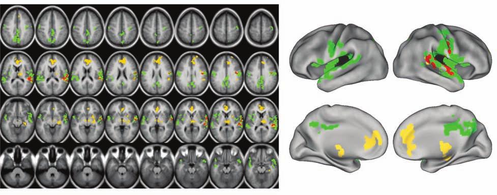 A. Anticevic et al a Overlap Between MD and LGN Thalamic Seeds: Bipolar Results 8 b lateral - L lateral - R 2 3 1 10 13 7 12 9 5 4 6 Surface-based View c Fisher r-to-z (Thalamic Coupling) MD