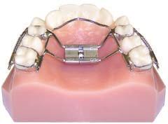 The MemRx ED - Lateral, A / P Development The MemRx ED is for lateral development of either arch and distalizing molars.