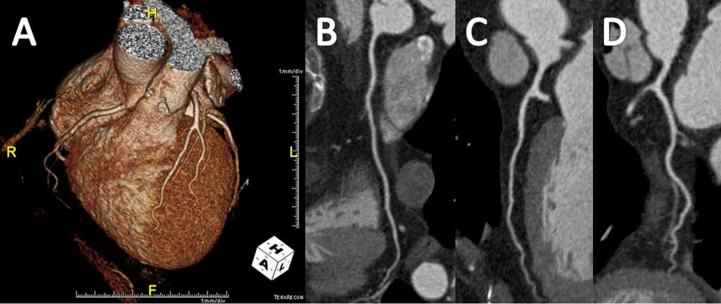 Computed Tomography Imaging of the Coronary Arteries http://dx.doi.org/10.5772/54044 Figure 2. CCTA of a 61 year old women.