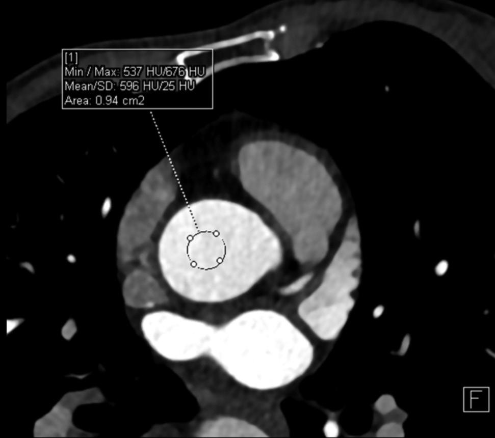 Coronary CT Angiography at 70 kvp Adopting Low Injection Speed of Contrast Medium A B C D E Fig. 4. 65-year-old woman (HR = 56 bpm, BMI = 19.9 kg/m 2, ED = 0.