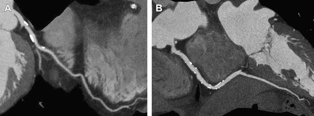Coronary CTA images acquired with the most recent CT hardware.