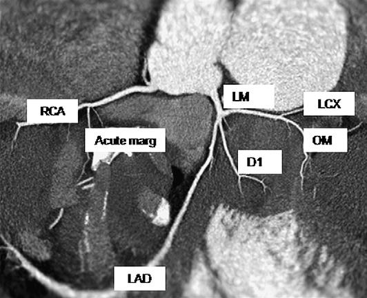 Coronary Artery Anatomy A 46-year-old woman who presented with chest pain. Curved MPR image of the RCA and LM with branches.