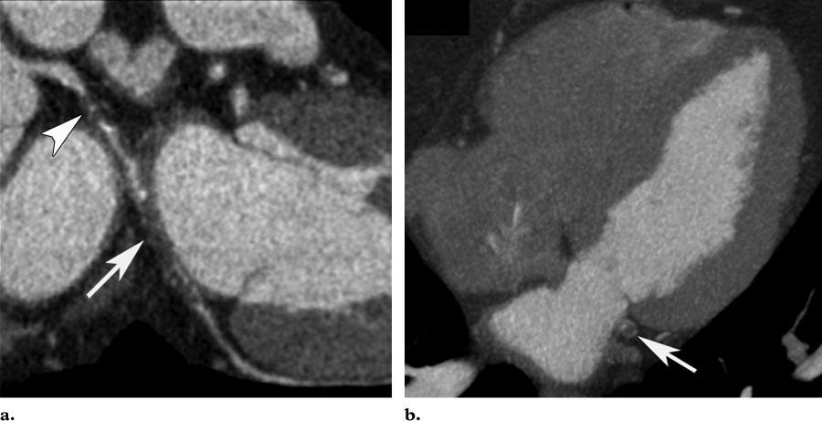 Multidetector CT images show acute