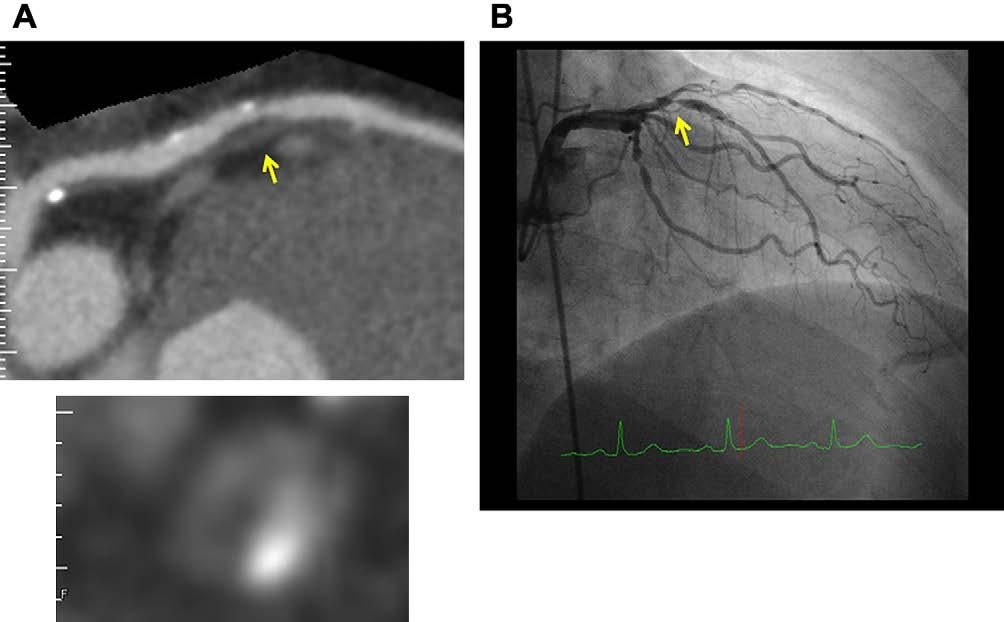 . A 57-year-old male patient with CT-verified vulnerable plaque who subsequently developed ACS.
