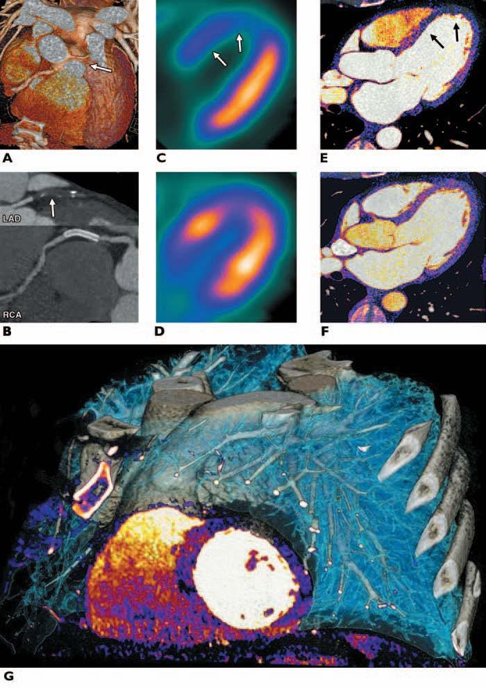 A 45-year-old man with recent infarction of inferior left ventricle wall and stent in, undergoing dual-energy CT and SPECT before coronary artery bypass grafting.