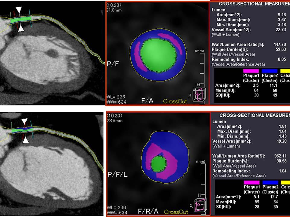 Evaluation of plaque characteristics using new plaque analyzing software (Plaque Labeling Method). Aatypical chest pain, underwent coronary CTA revealed 25% stenotic lesion at the left main trunk.