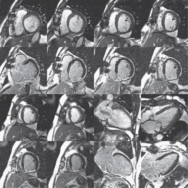 Images from a typical patient scan. Cine and delayed-enhancement images are acquired at six to eight short axis locations and at two to three long-axis locations during repeated breath holds.