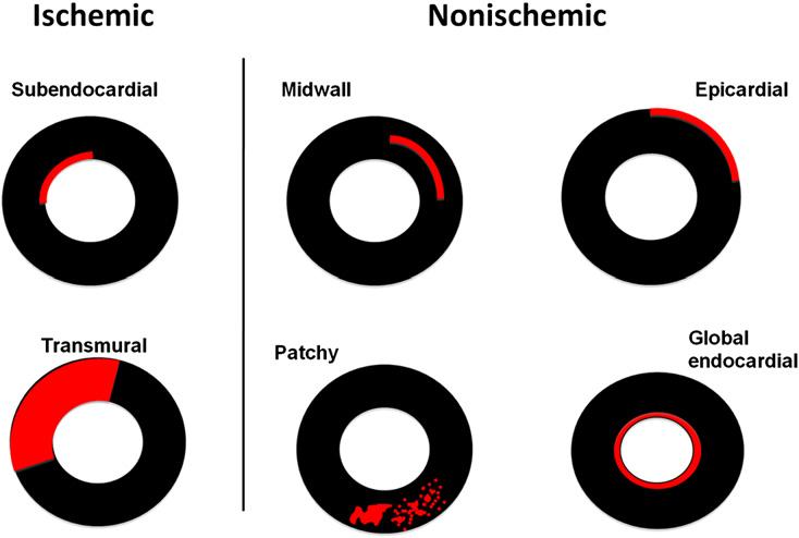 Diagram illustrating the difference between the DE observed in ischemic and nonischemic diseases.