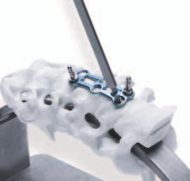 Surgical Technique (Continued) Bone Screw Insertion The appropriate length and diameter of the bone screw can be verified using the Bone Screw Gauge on the Bone Screw Caddy.