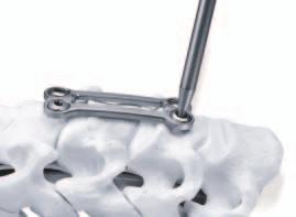 Turn the bone screw counterclockwise to disengage the bone screw threads. A Plate Holder may be used to stabilize the plate during removal.
