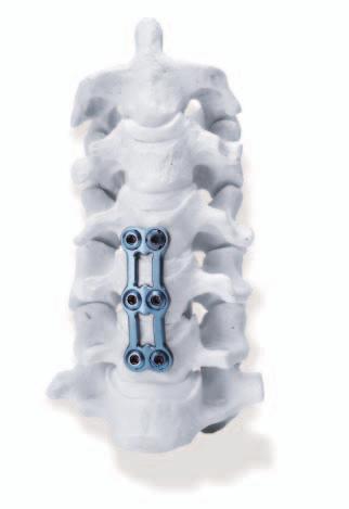 Introduction The Cyprus Anterior Cervical Plate System offers surgeons simplicity, efficiency and versatility.