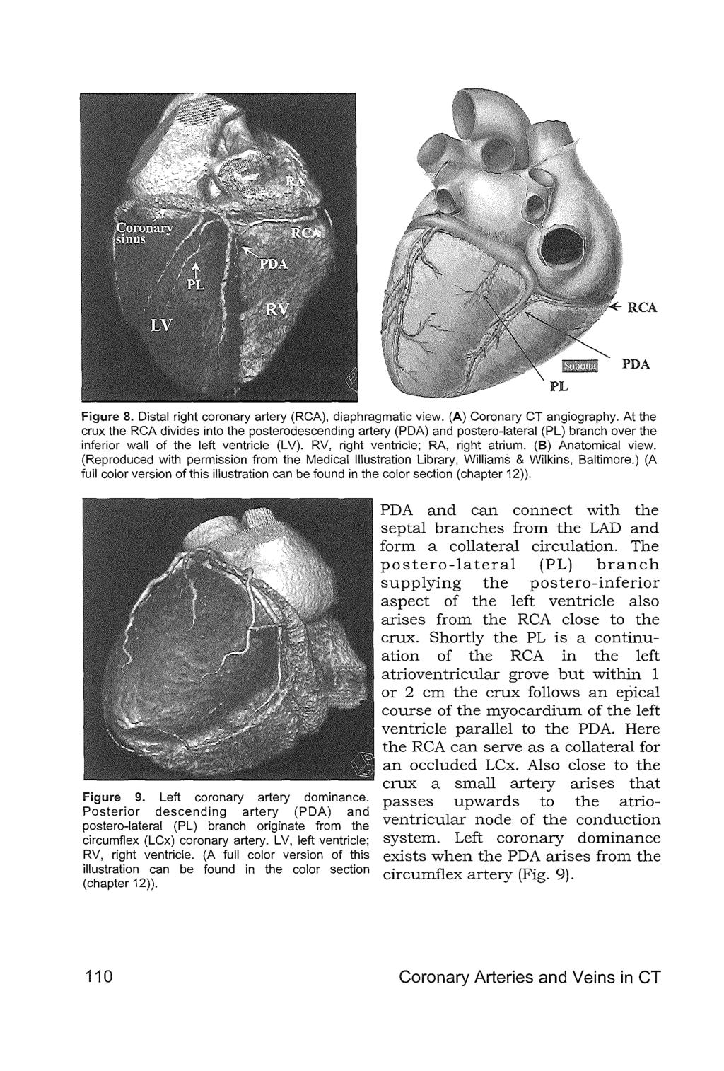 RCA Figure 8. Distal right coronary artery (RCA), diaphragmatic view. (A) Coronary CT angiography.