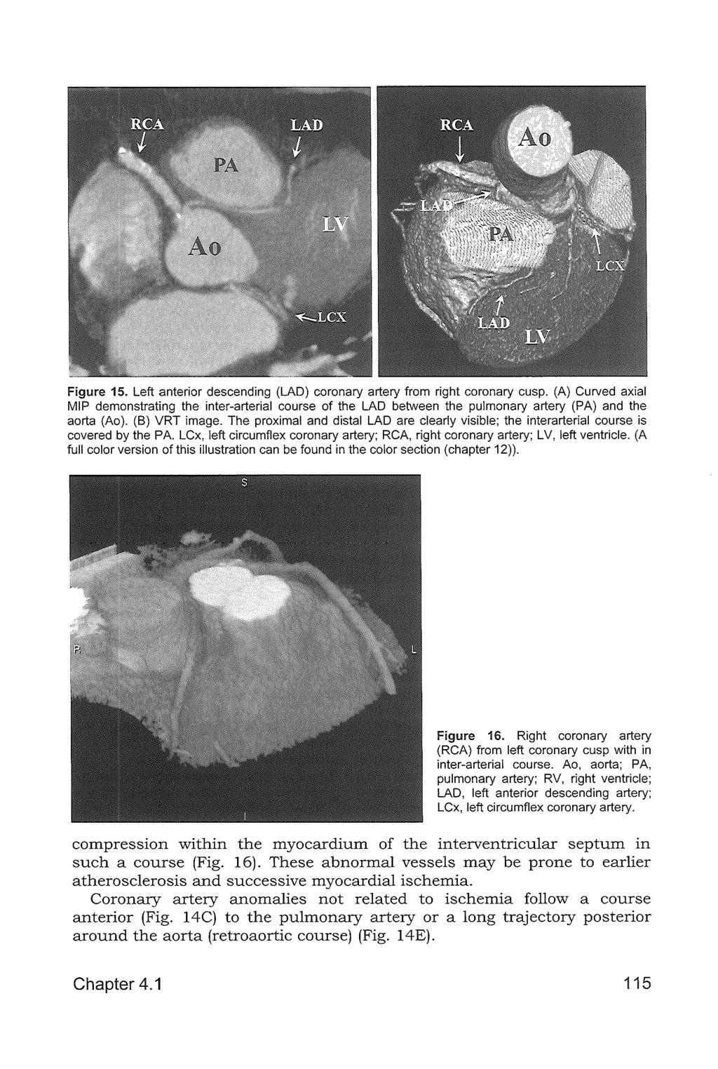 Figure 15. Left anterior descending (LAD) coronary artery from right coronary cusp.