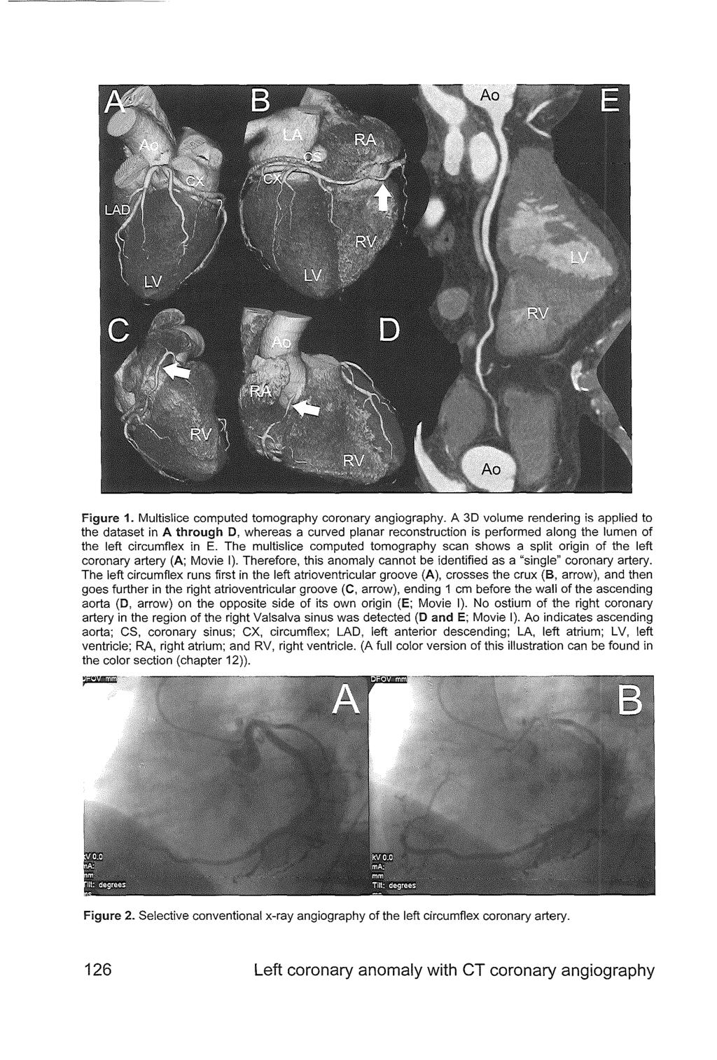 Figure 1. Multislice computed tomography coronary angiography.