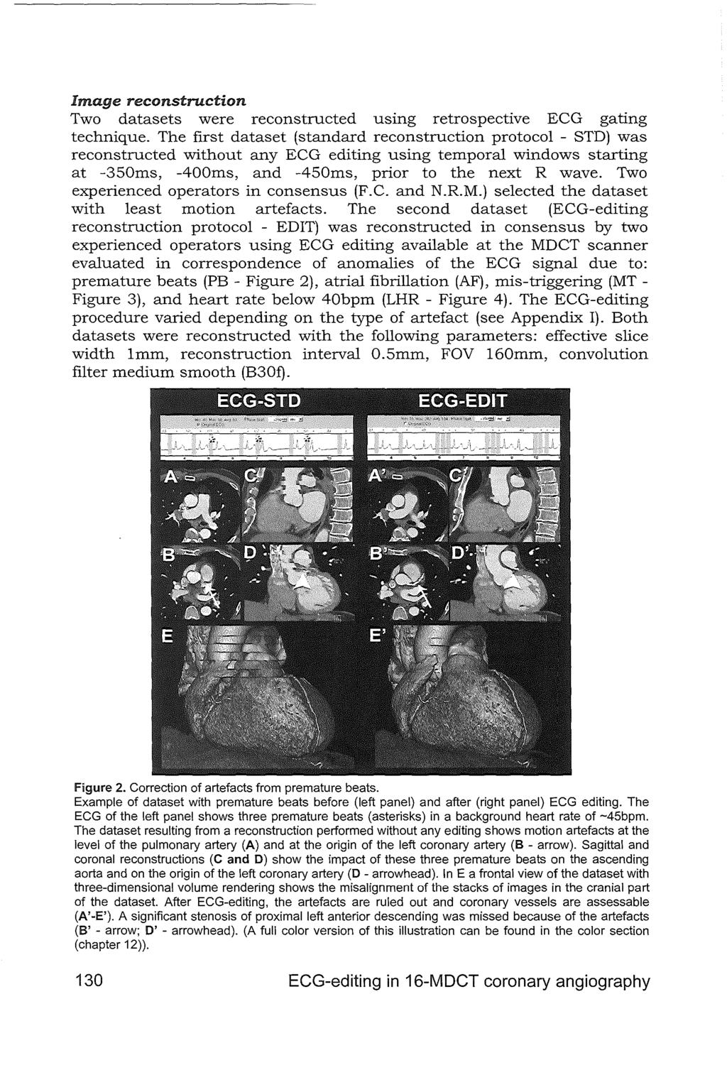 Image reconstruction Two datasets were reconstructed using retrospective ECG gating technique.