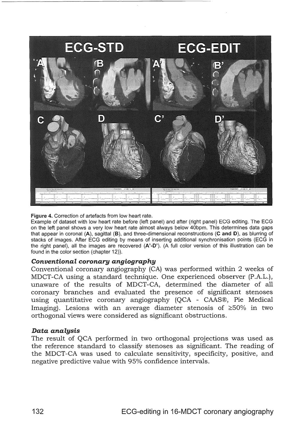 Figure 4. Correction of artefacts from low heart rate. Example of dataset with low heart rate before (left panel) and after (right panel) ECG editing.