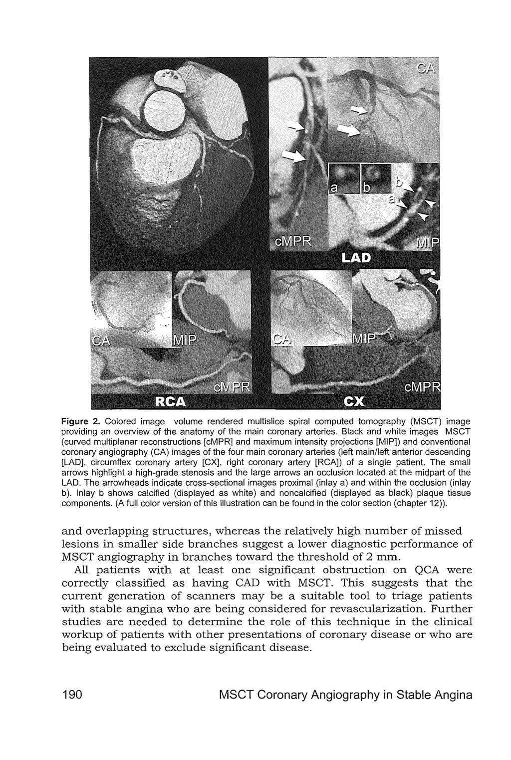 Figure 2. Colored image volume rendered multislice spiral computed tomography (MSCT) image providing an overview of the anatomy of the main coronary arteries.