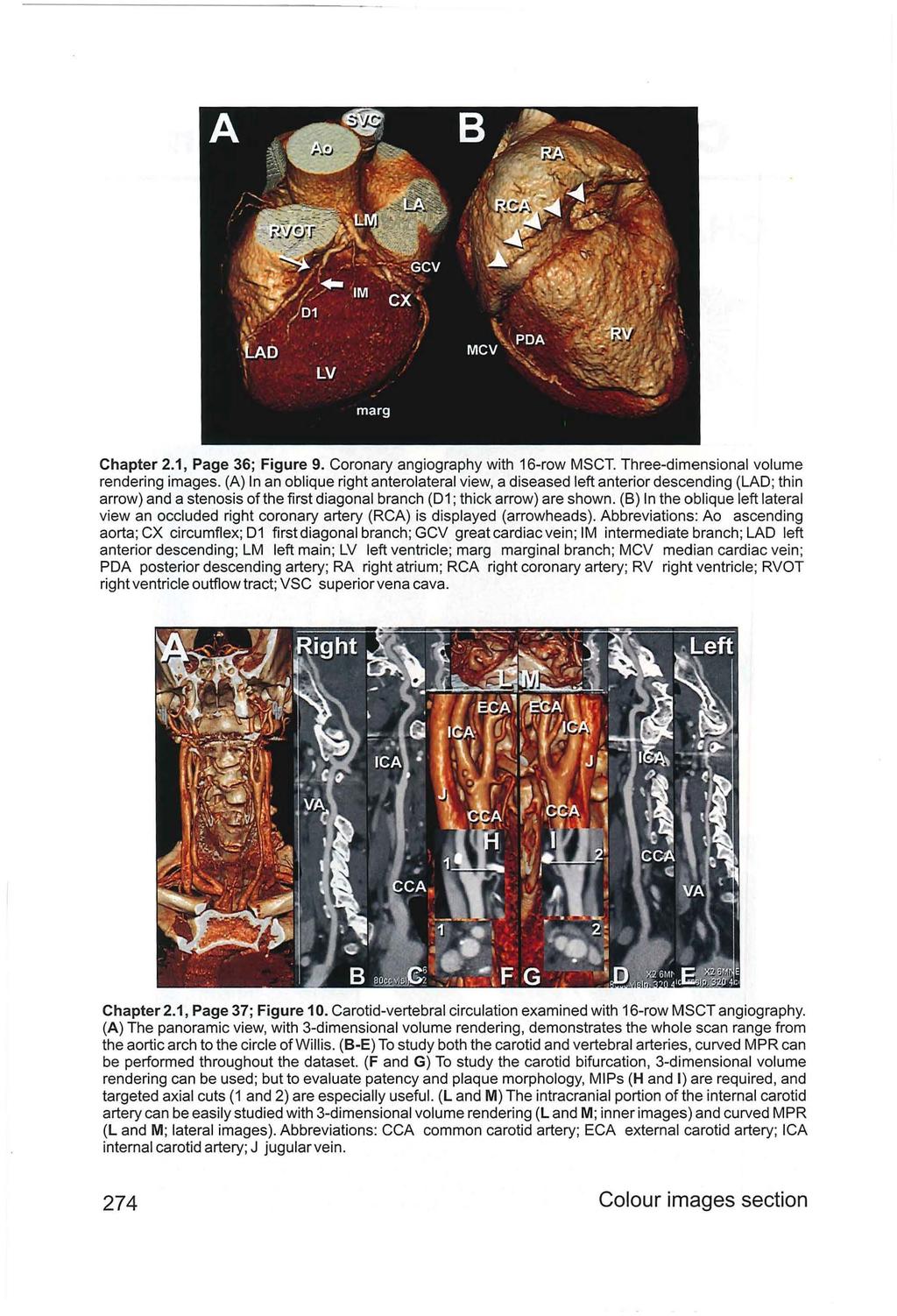 Chapter 2.1, Page 36; Figure 9. Coronary angiography with 16-row MSCT. Three-dimensional volume rendering images.