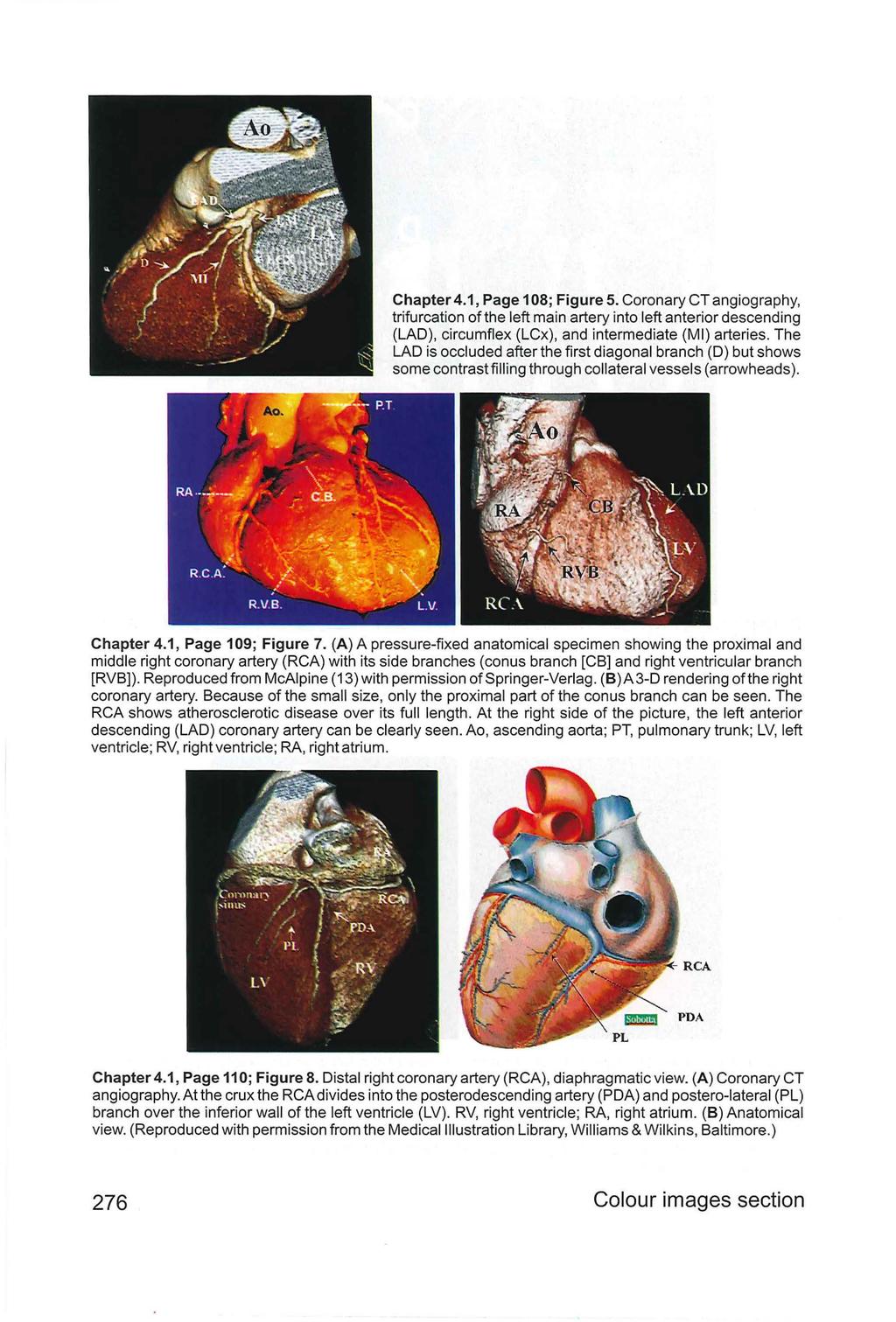 Chapter4.1, Page 108; Figure 5. Coronary CTangiography, trifurcation of the left main artery into left anterior descending (LAD), circumflex (LCx), and intermediate (MI) arteries.