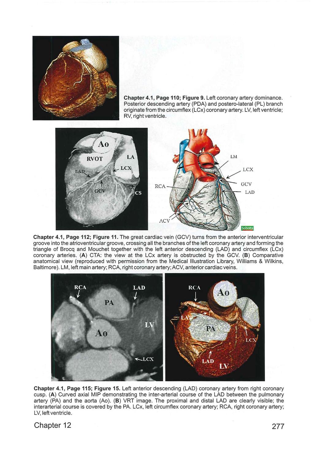 Chapter 4.1, Page 11 0; Figure 9. Left coronary artery dominance. Posterior descending artery (PDA) and postero-lateral (PL) branch originate from the circumflex (LCx) coronary artery.