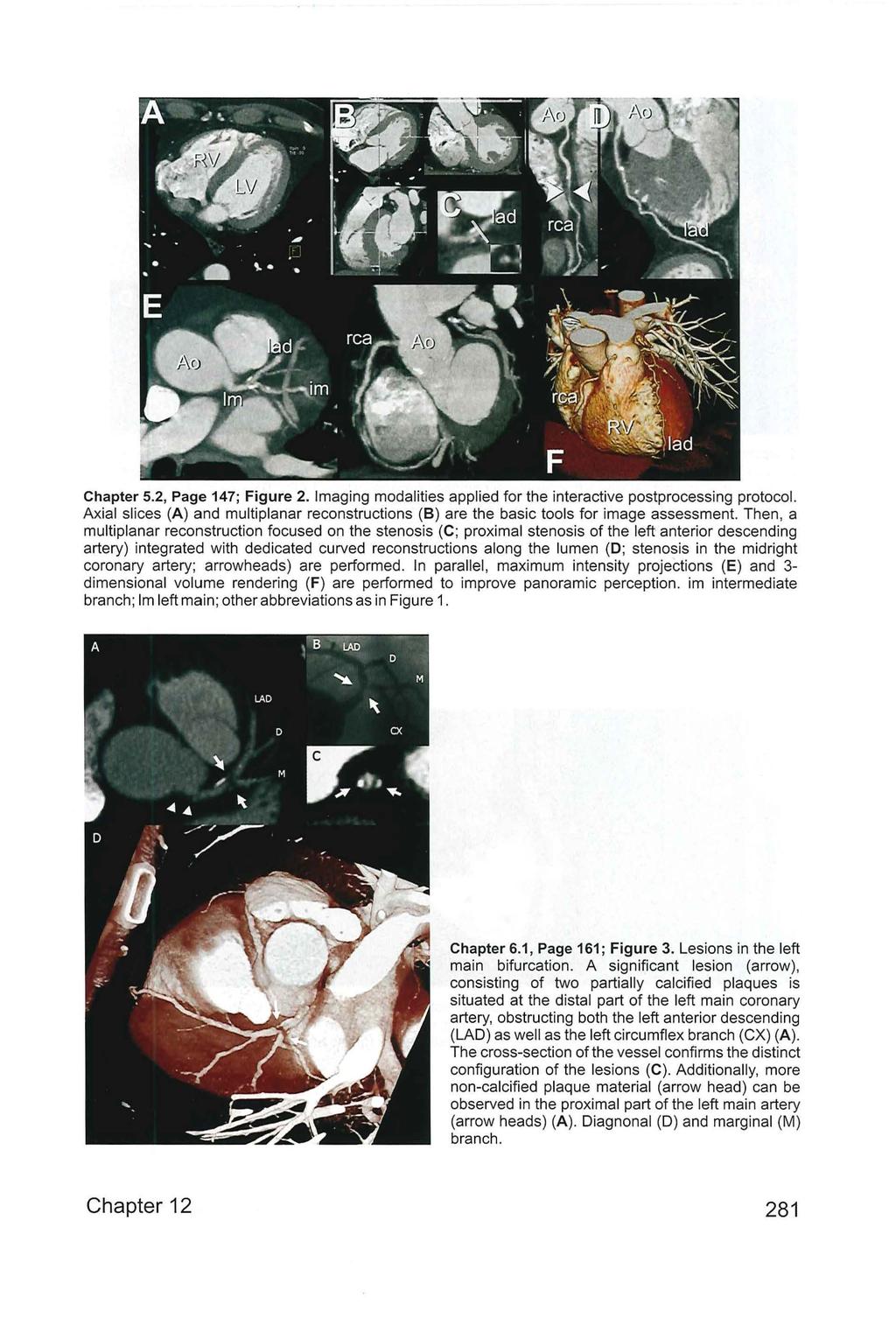 Chapter 5.2, Page 147; Figure 2. Imaging modalities applied for the interactive postprocessing protocol. Axial slices (A) and multiplanar reconstructions (B) are the basic tools for image assessment.