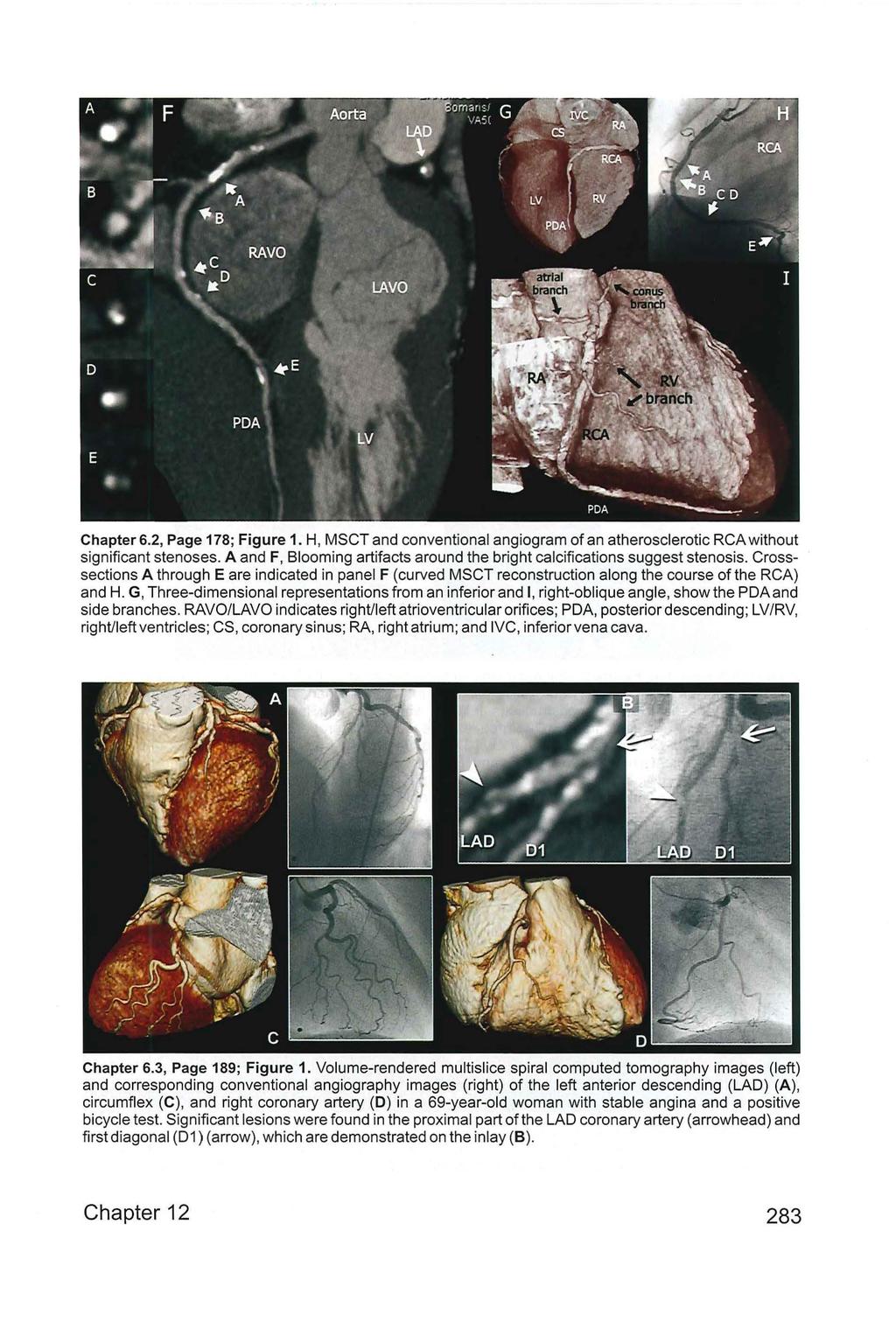 Chapter 6.2, Page 178; Figure 1. H, MSCT and conventional angiogram of an atherosclerotic RCA without significant stenoses.
