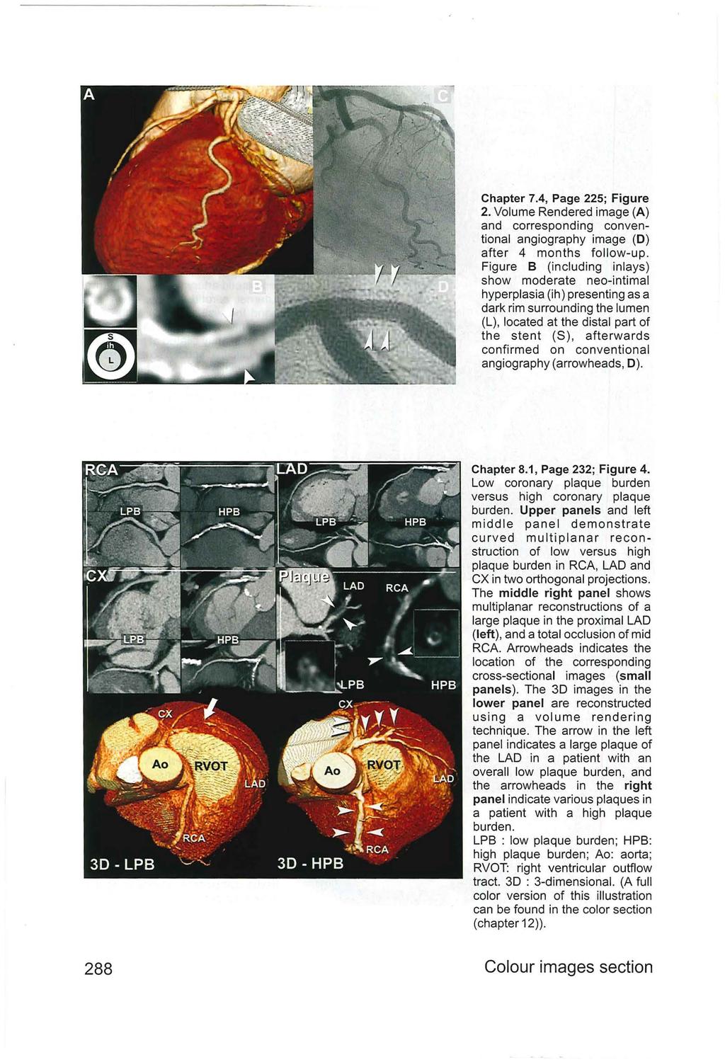 Chapter 7.4, Page 225; Figure 2. Volume Rendered image (A) and corresponding conventional angiography image (D) after 4 months follow-up.