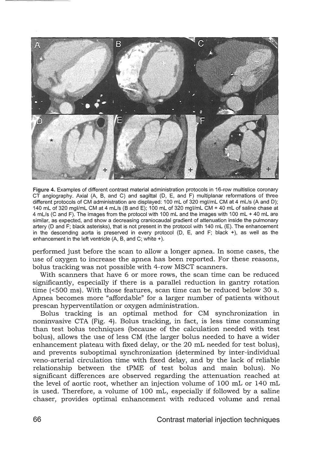 Figure 4. Examples of different contrast material administration protocols in 16-row multislice coronary CT angiography.