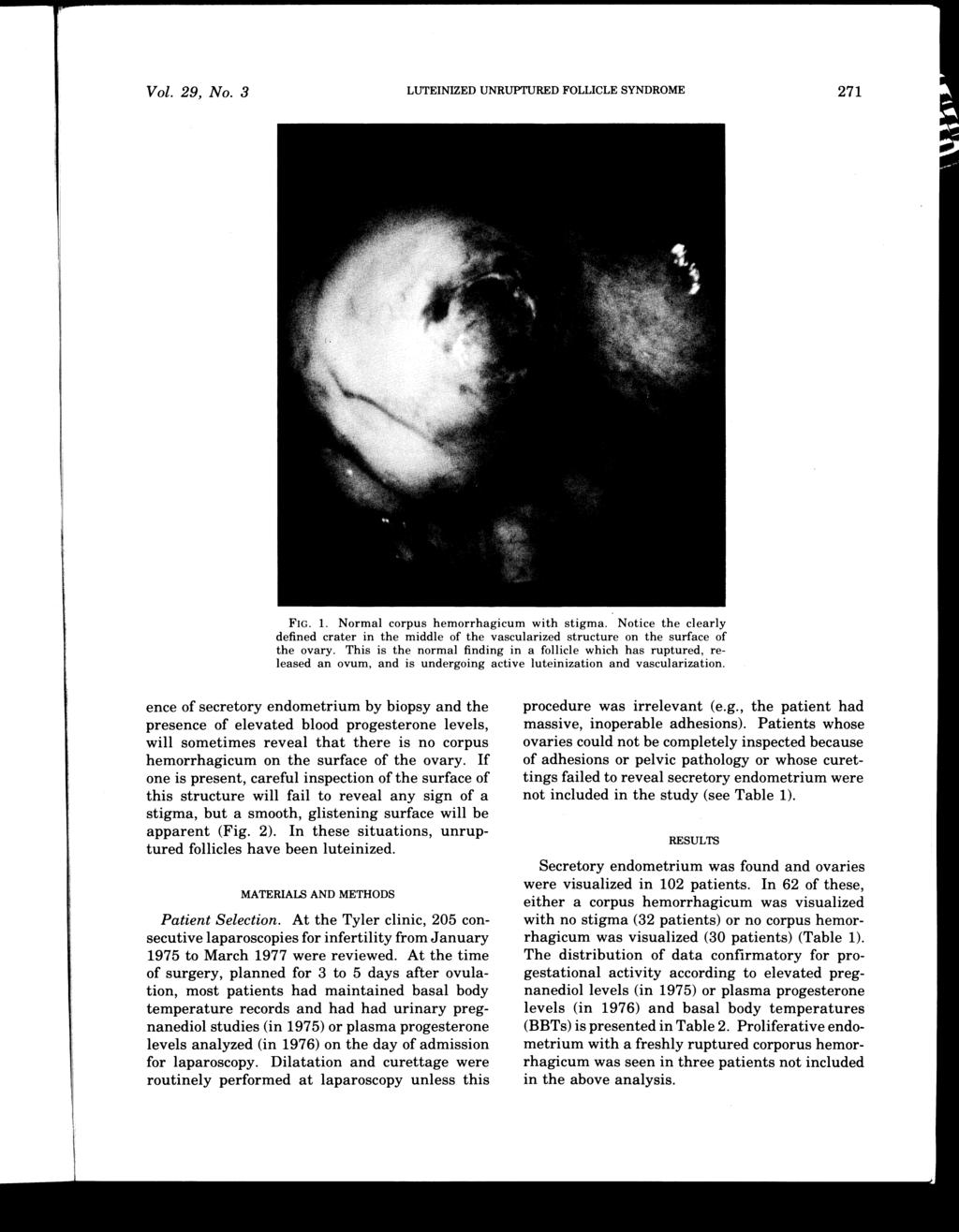 LUTEINIZED UNRUPTURED FOLLICLE SYNDROME Vol. 29, No.3 271 FIG. 1. Normal corpus hemorrhagicum with stigma.